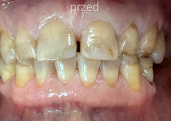 Before-Zmiany