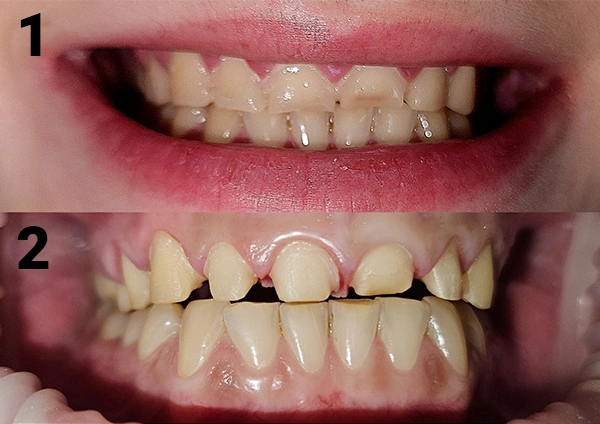 Before-Metamorfoza 3