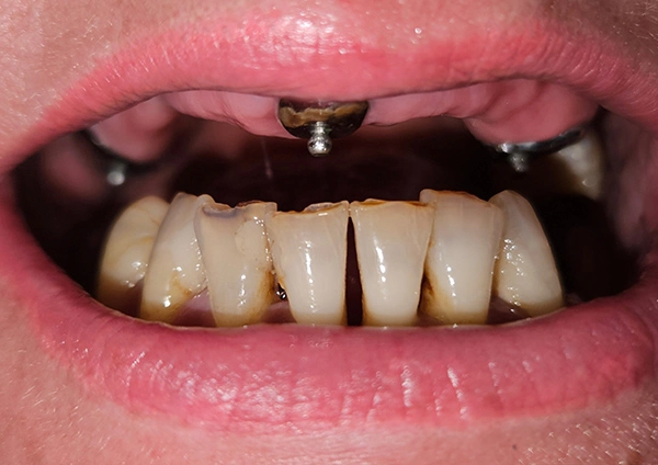 Before-Metamorfoza 4