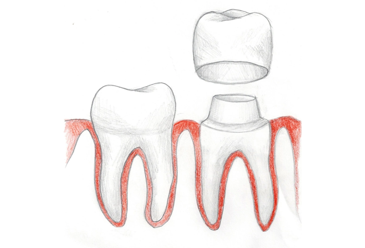 Protetyka stomatologiczna – Dent-a-Clinic Bardo