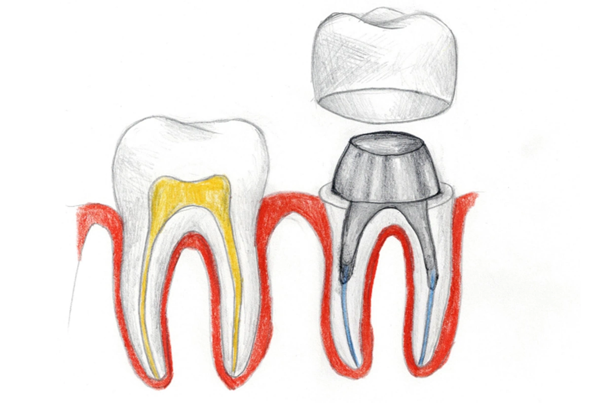 Protetyka - Dent-a-Clinic