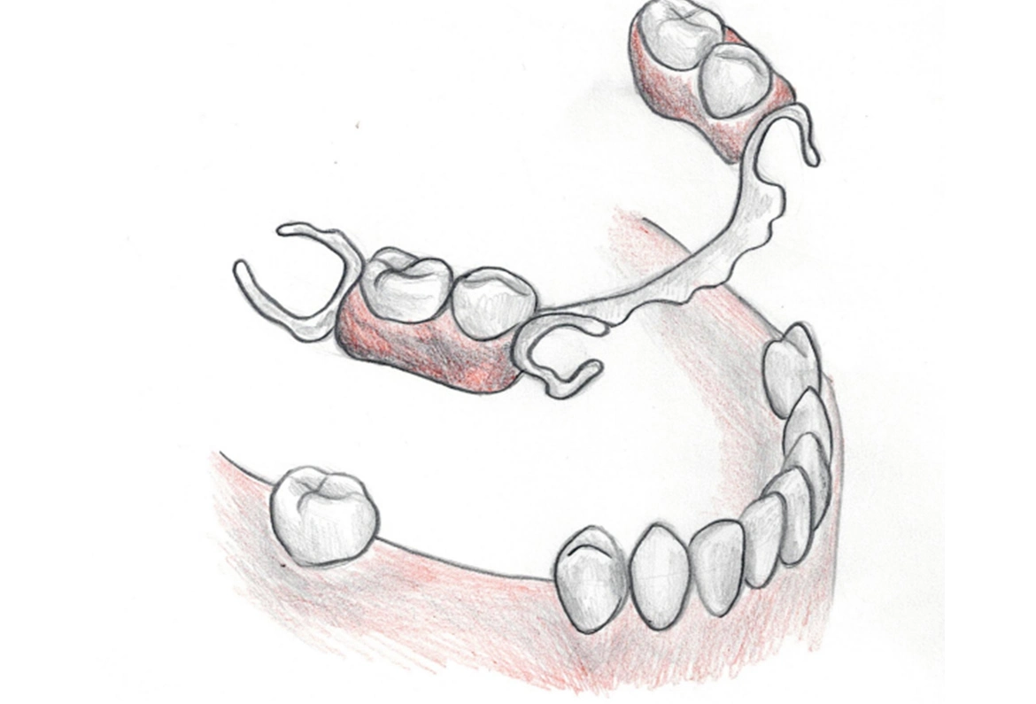 Protetyka - Dent-a-Clinic