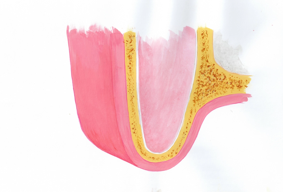 Chirurgia podniesienia zatoki - Dent-a-Clinic