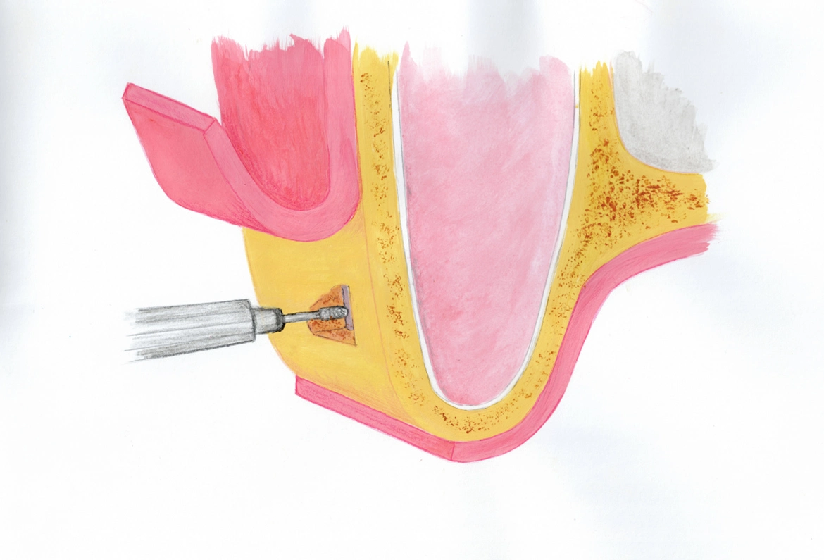 Chirurgia podniesienia zatoki - Dent-a-Clinic