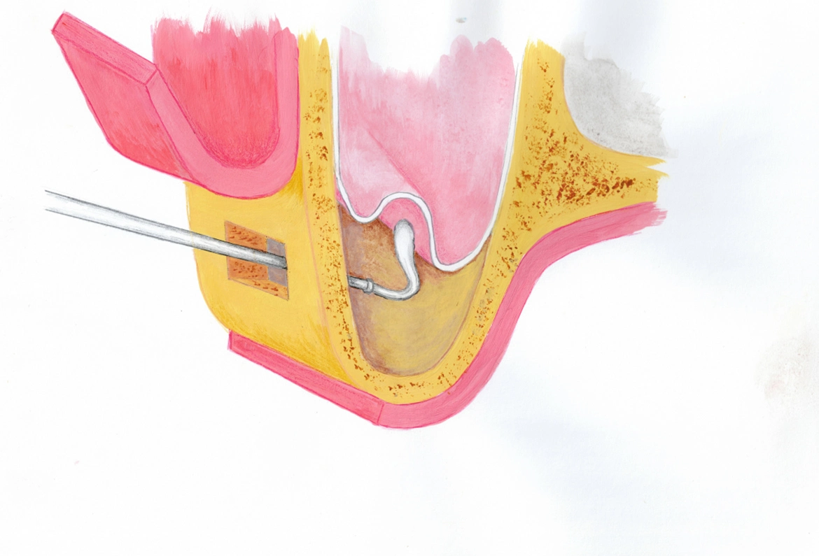 Chirurgia podniesienia zatoki - Dent-a-Clinic