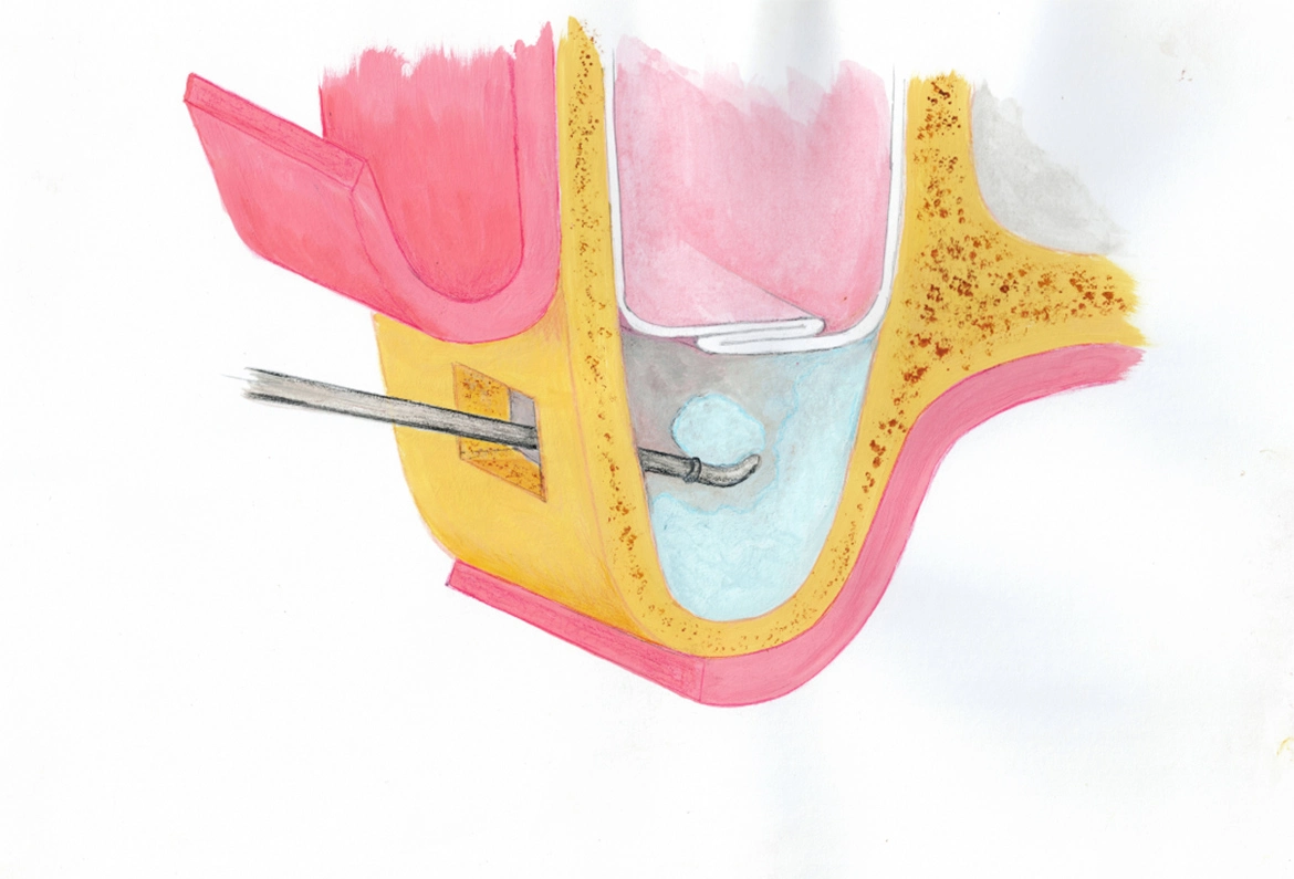 Chirurgia podniesienia zatoki - Dent-a-Clinic